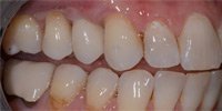 Patient's mouth after bone grafting and an implant-supported crown