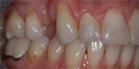 Patient's mouth with a missing tooth