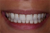 Patient's smile after dental implants
