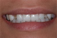 Patient's smile before dental implants