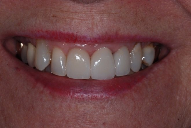 Patient's smile after a dental implant