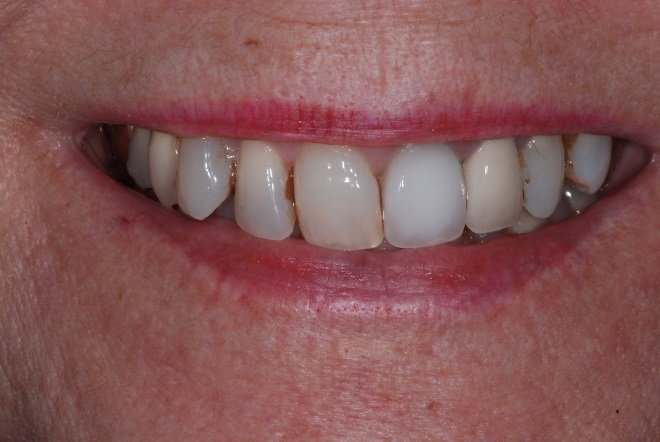 Patient's smile with a tooth unable to support a crown before a dental implant