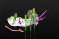 Computer-generated model of dental implant placement