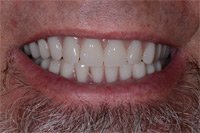 Patient's smile after dental implants