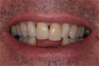 Patient's smile before dental implants