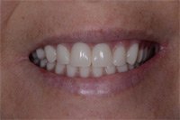 Patient's smile after dental implants