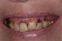 Patient's smile with rotted teeth due to periodontal disease before dental implants