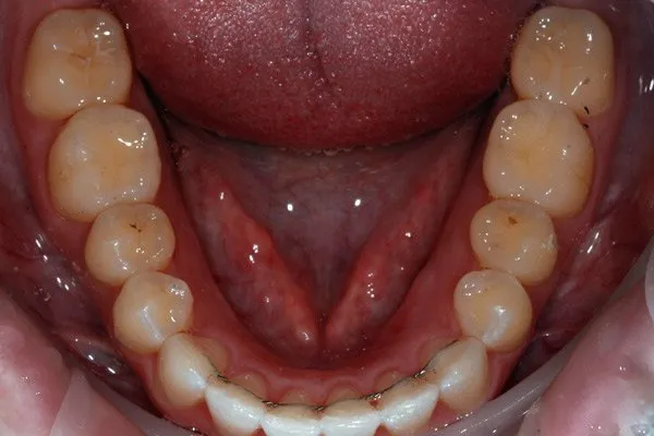 Patient's teeth after Invisalign