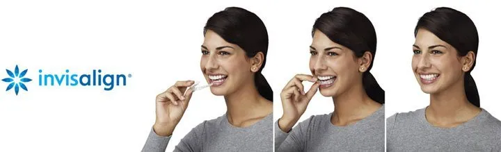 Invisalign logo with a woman wearing Invisalign clear braces