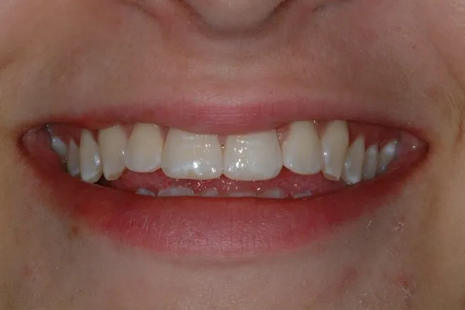 Patient's smile after Instant Orthodontics