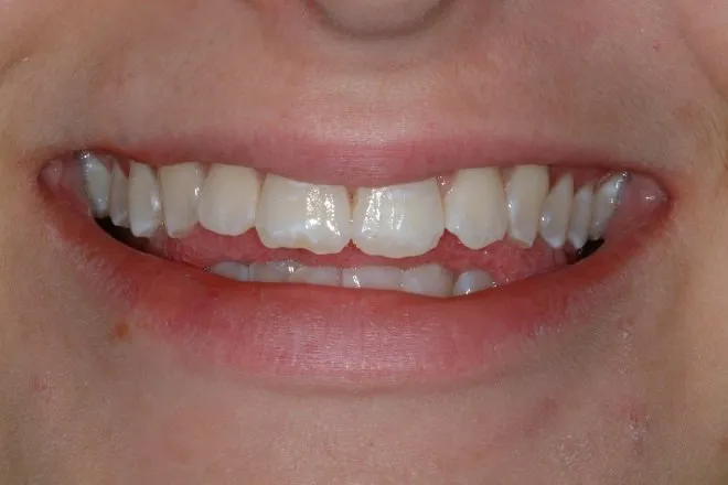 Patient's smile before Instant Orthodontics