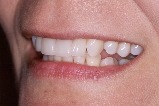 Patient's smile after Instant Orthodontics