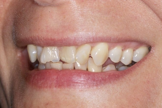 Patient's smile before Instant Orthodontics