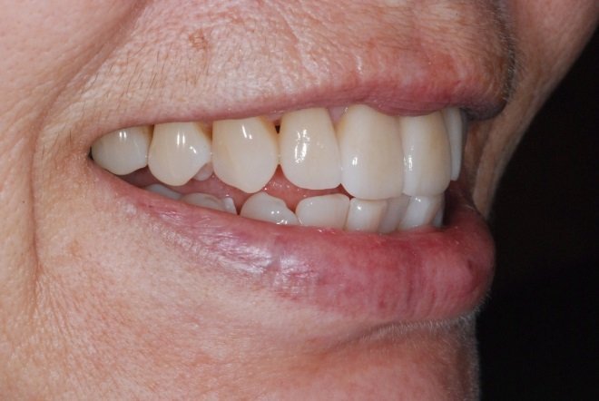 Patient's smile after Instant Orthodontics