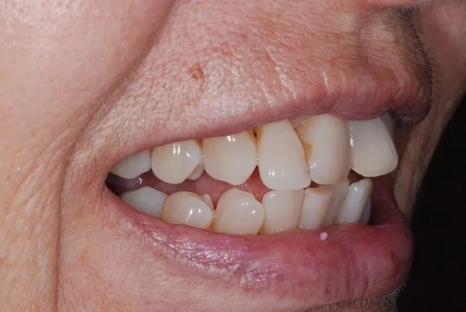 Patient's smile before Instant Orthodontics