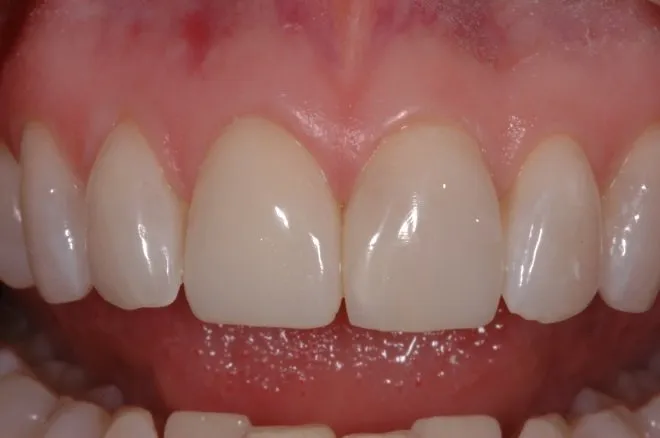 Patient's smile after Instant Orthodontics