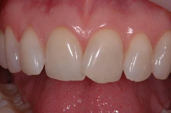 Patient's smile before Instant Orthodontics