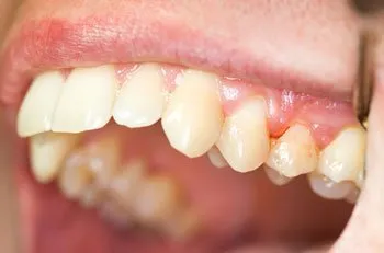 gums with gingivitis