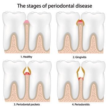 perio disease stage graphic