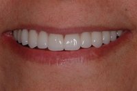 Patient's smile after dental crowns