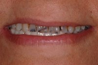 Patient's smile before dental crowns