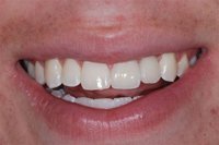 Patient's smile after dental crowns