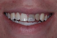 Patient's smile before dental crowns