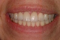 Patient's smile after dental crowns