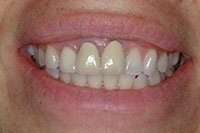 Patient's smile before dental crowns