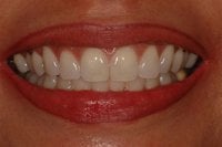 Mouth before porcelain veneers
