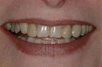 Mouth before porcelain veneers