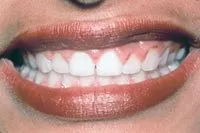 Mouth before porcelain veneers