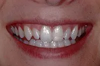 Mouth before porcelain veneers