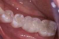 Patient's mouth after a fixed implant