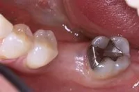 Patient's mouth with a missing bottom tooth before a fixed implant
