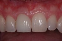 After Dental Implant was used to replaced broken tooth