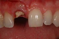 Patient's mouth with a broken teeth before a dental implants