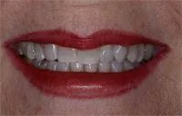 Patient's smile after Six Month Smiles treatment