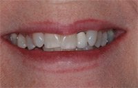 Patient's smile before Six Month Smiles treatment