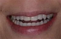 Patient's smile after Six Month Smiles treatment