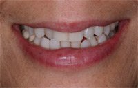 Patient's smile before Six Month Smiles treatment