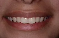 Patient's smile after Six Month Smiles treatment