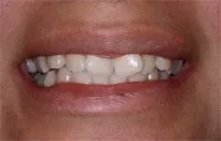 Patient's smile before Six Month Smiles treatment