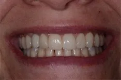 patient's smile after dental treatment