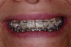patient's smile before dental treatment
