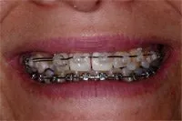 Mouth with braces before porcelain veneers