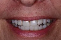Mouth before porcelain veneers