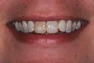 Mouth before porcelain veneers