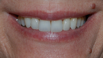Patient's teeth after Invisalign