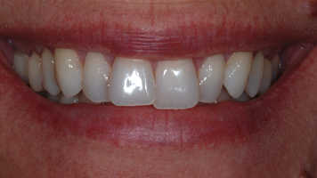 Patient's teeth before Invisalign